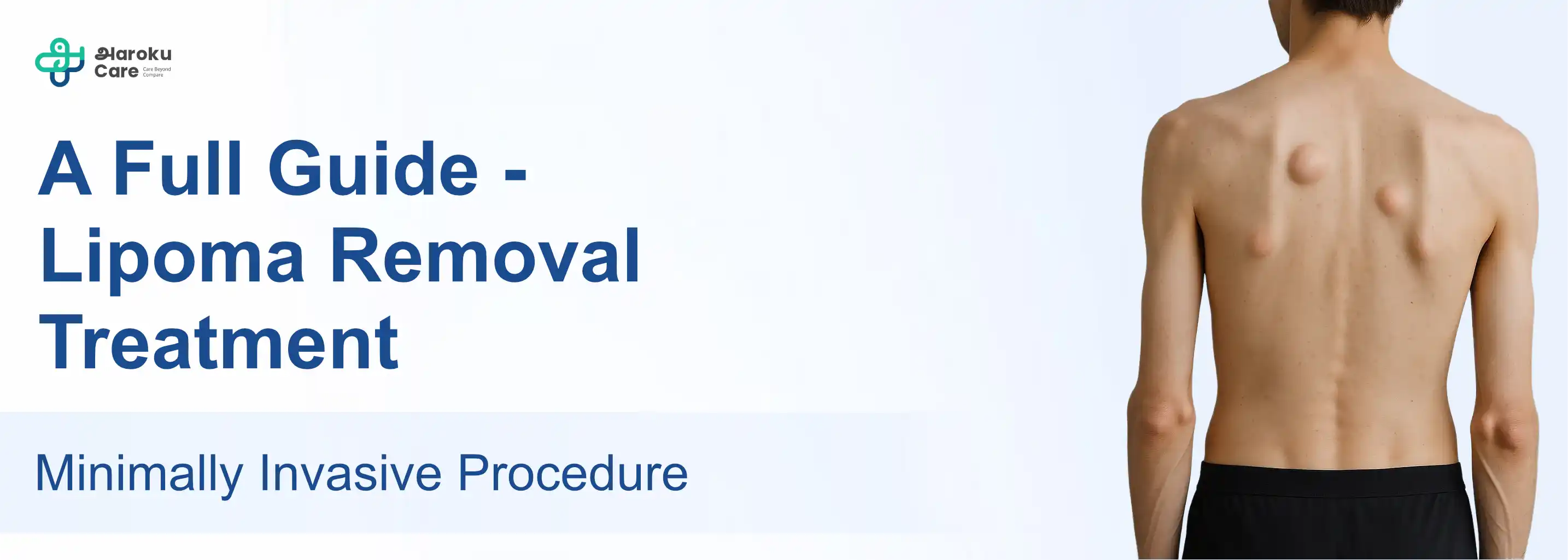Male chest with gynecomastia before treatment showing enlarged breast tissue