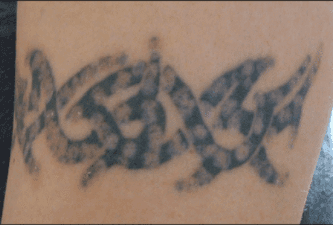 Black tribal-style tattoo in late healing with significant ink reduction after non-laser tattoo removal.