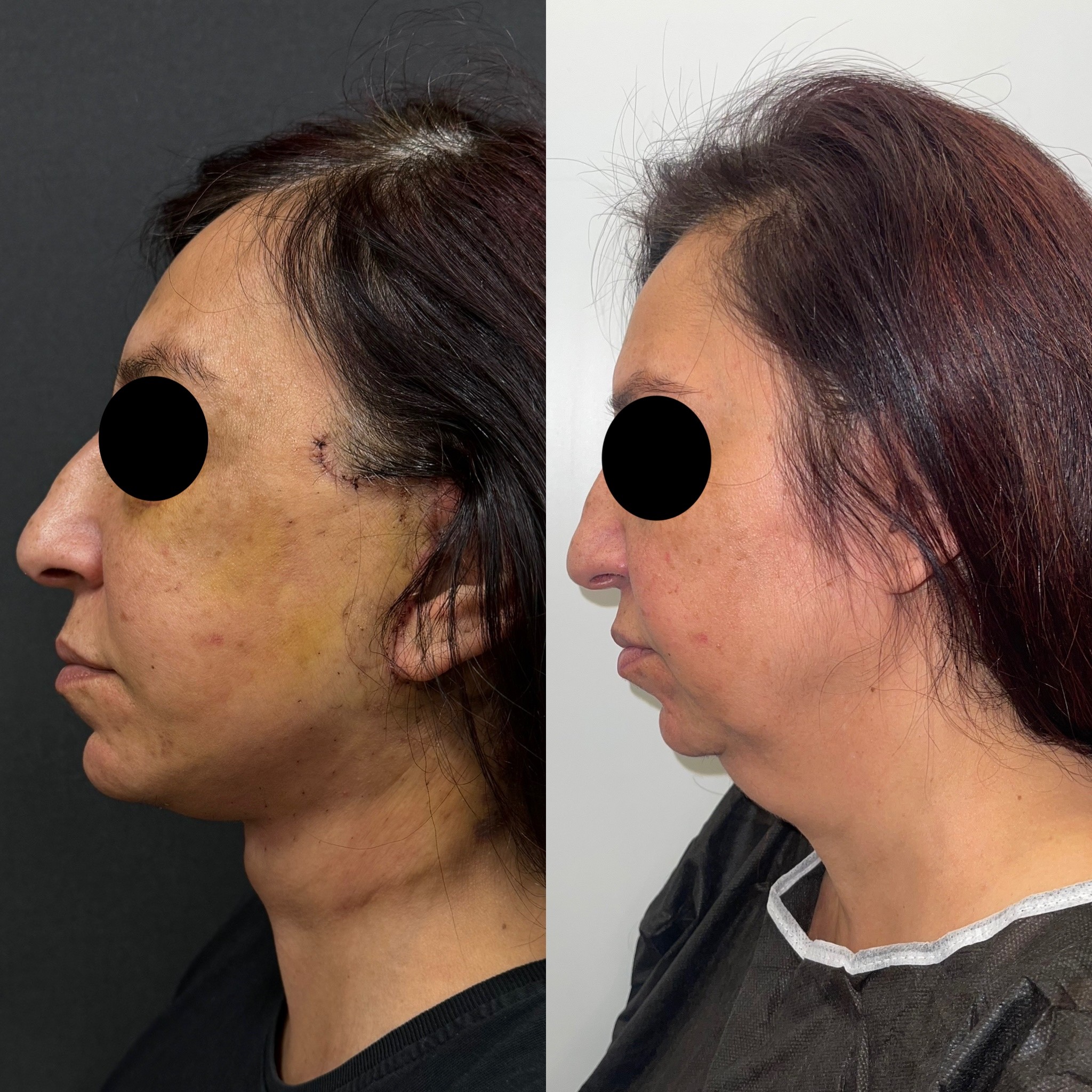 turkey neck deformity neck lift before after left side view