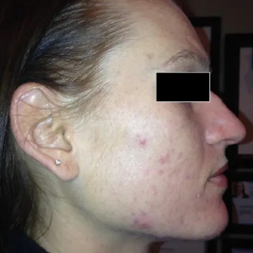 After LED light therapy at The Vancouver Aesthetician — acne cleared and blackheads visibly reduced for cleaner skin