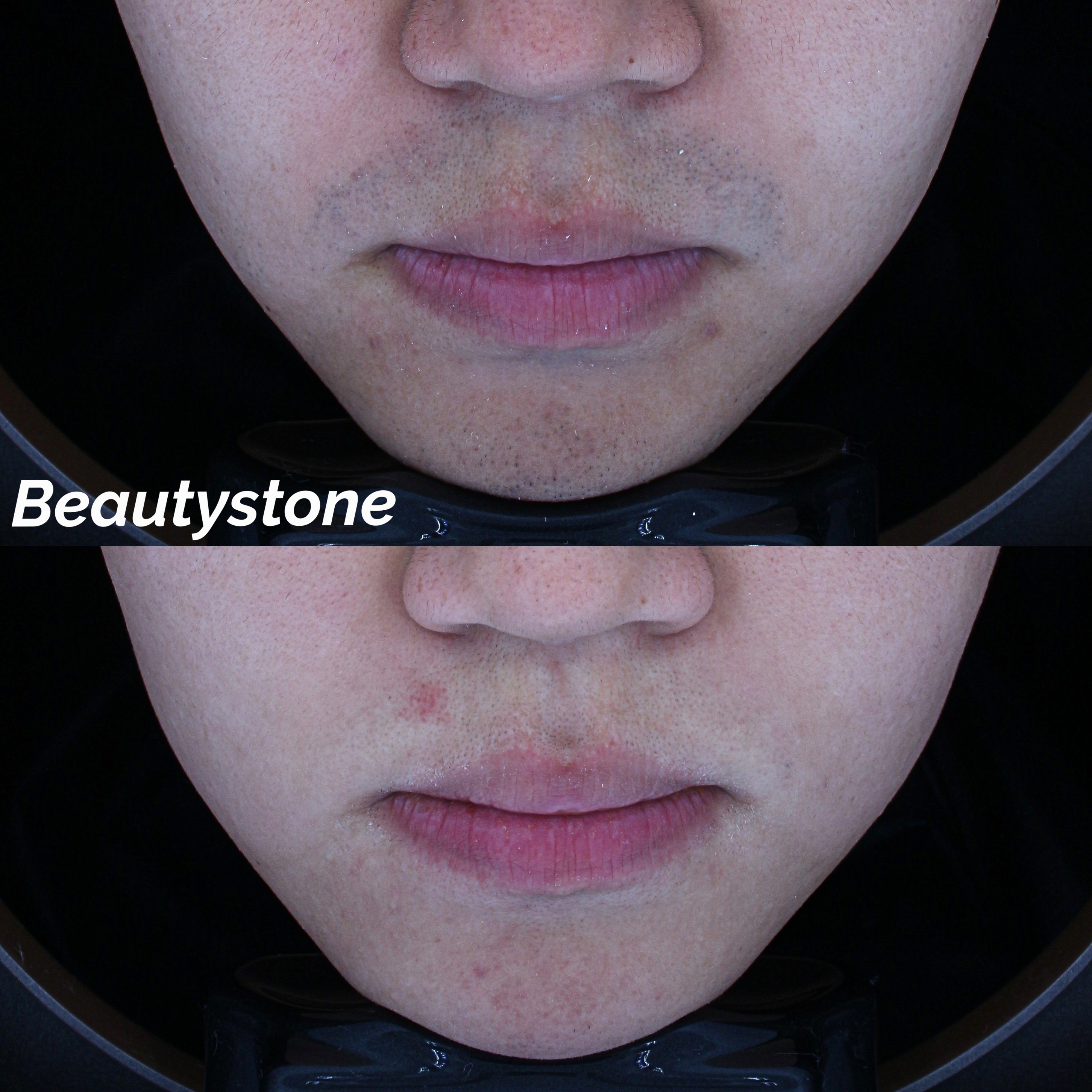 젠틀맥스프로플러스(젠맥프플)5회전후사진