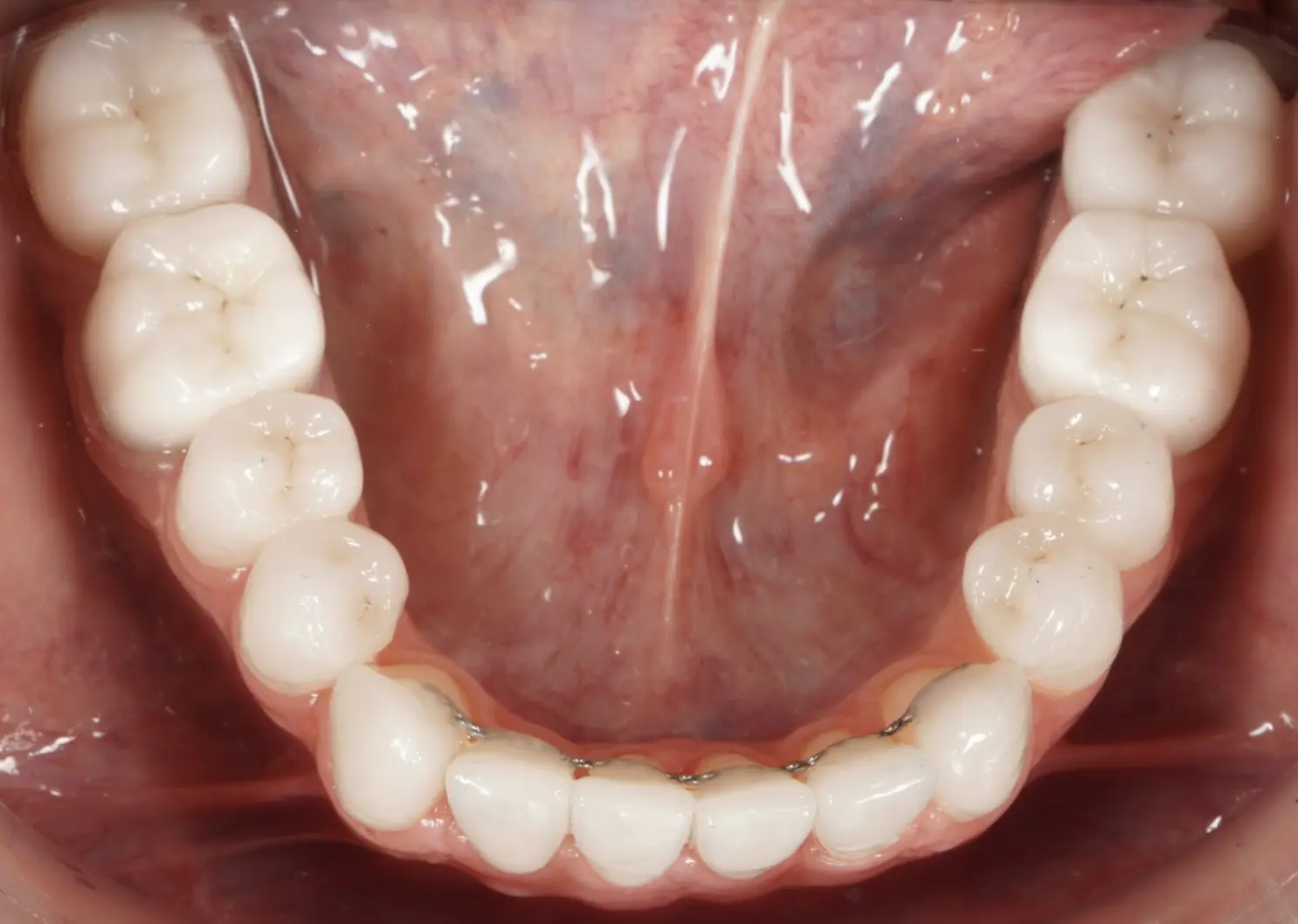 Before and after definitive ceramic restorations (crowns, veneers)