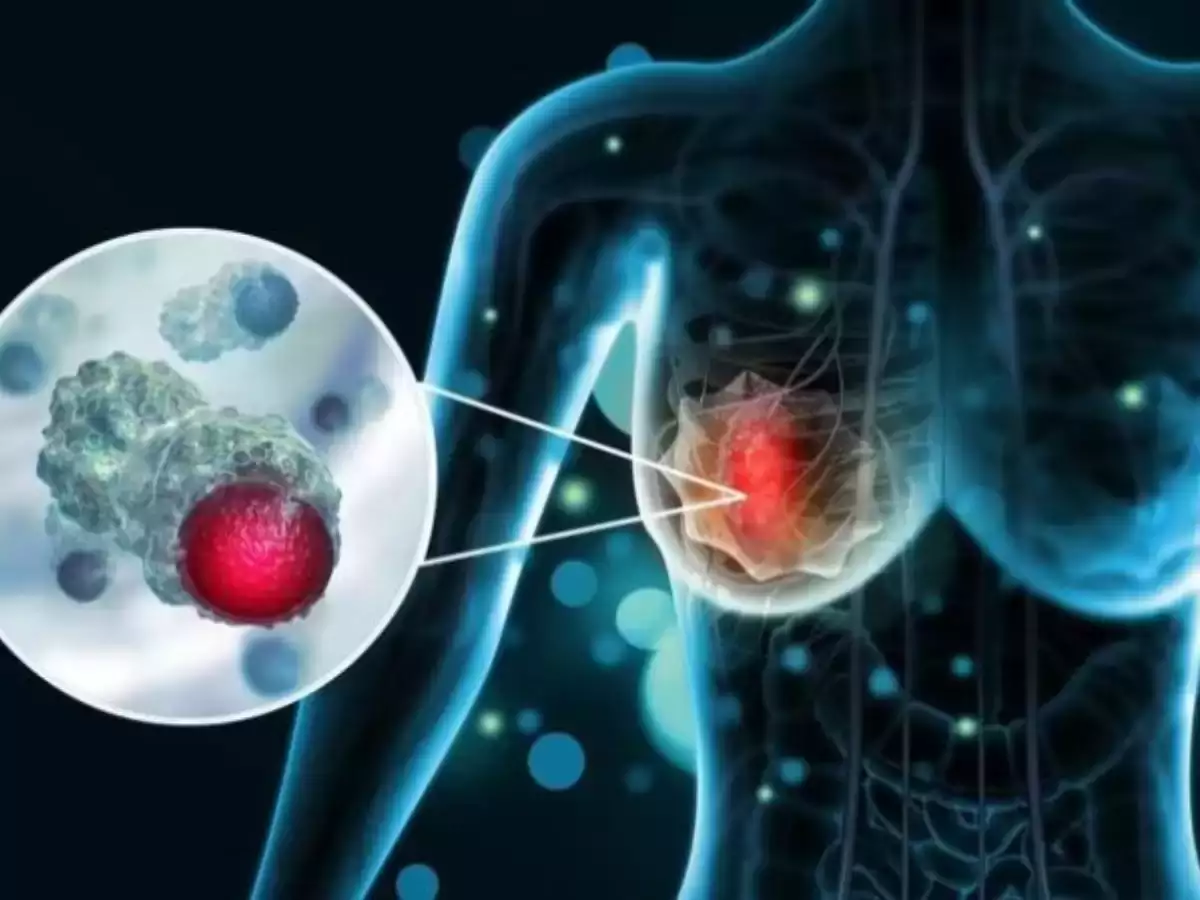 Visual representation of breast cancer cells highlighted in a human anatomy illustration