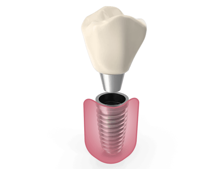 Dental implant 3d model