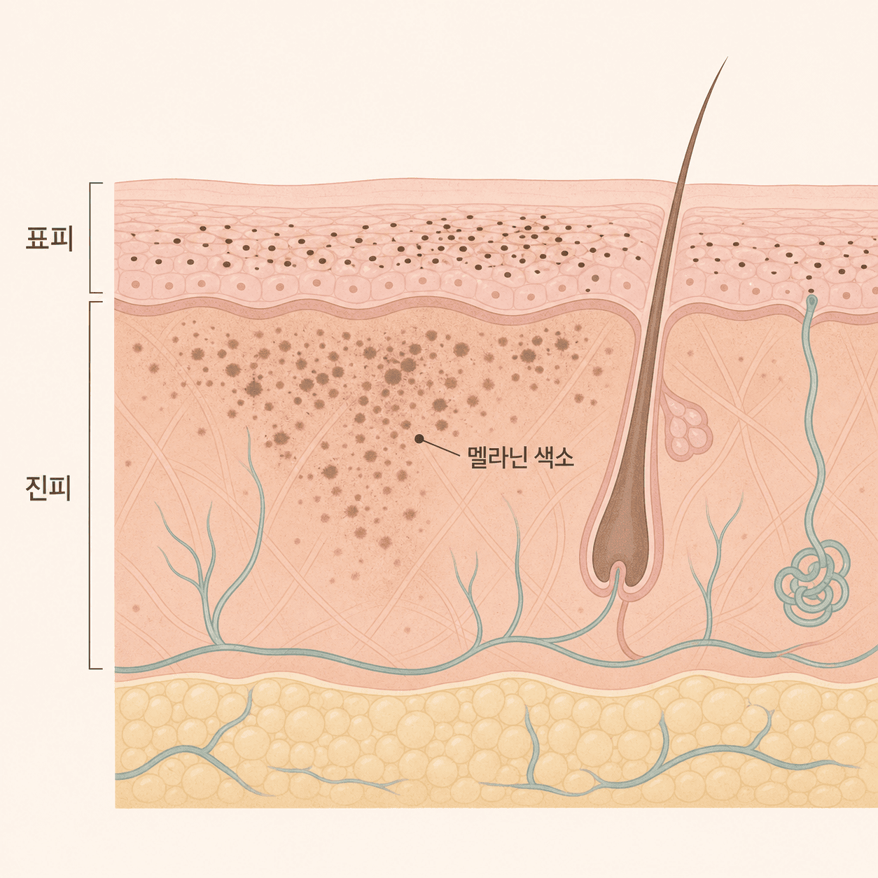 표피에 뭉친 색소와 진피까지 번진 색소의 차이