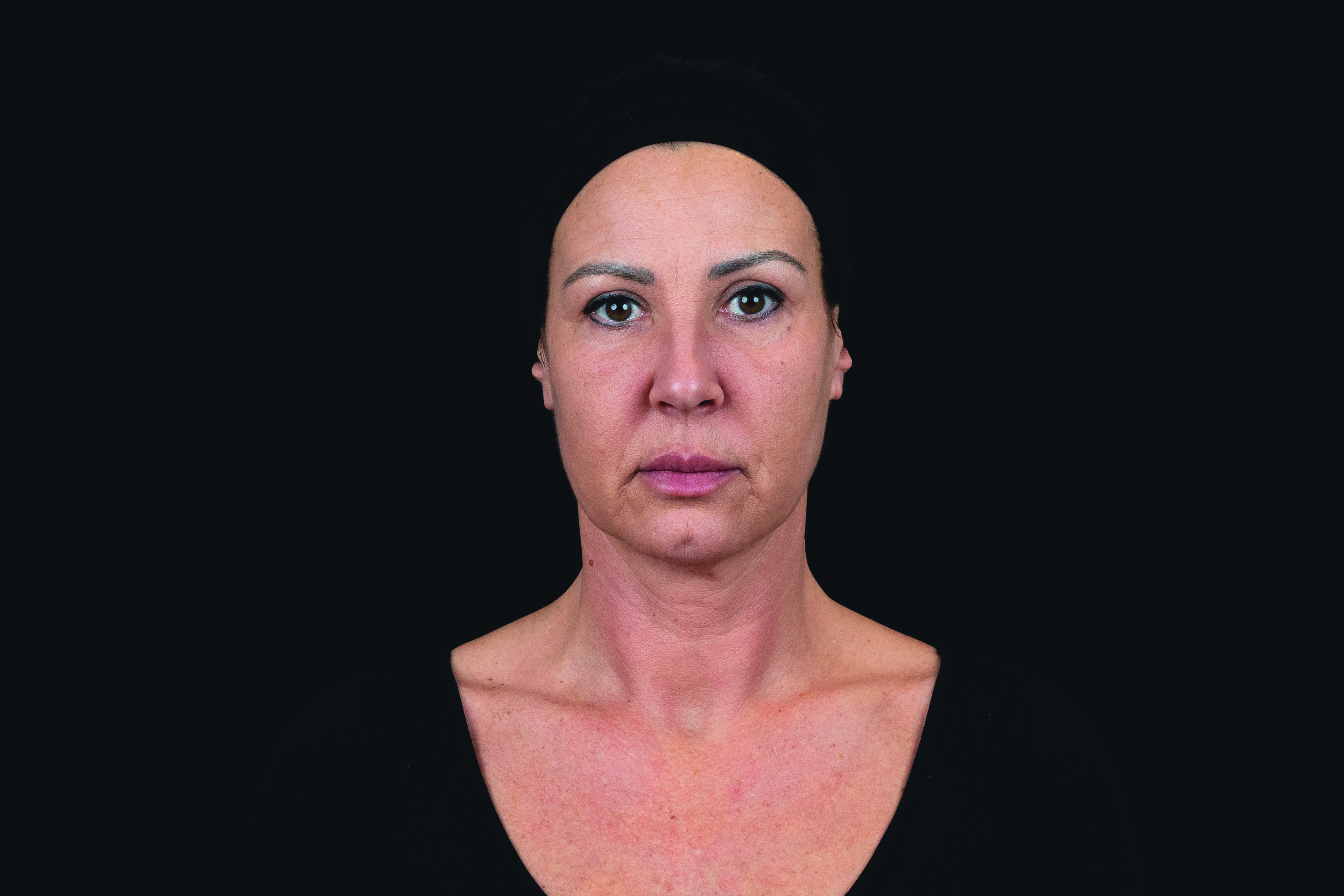 Female model after dermal filler treatment with Croma Saypha Volume Lidocaine