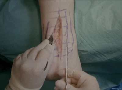 Ankle approach posterolateral