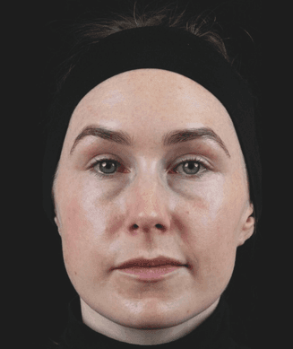 Female in her 30s before Saypha hyaluronic acid dermal filler treatment
