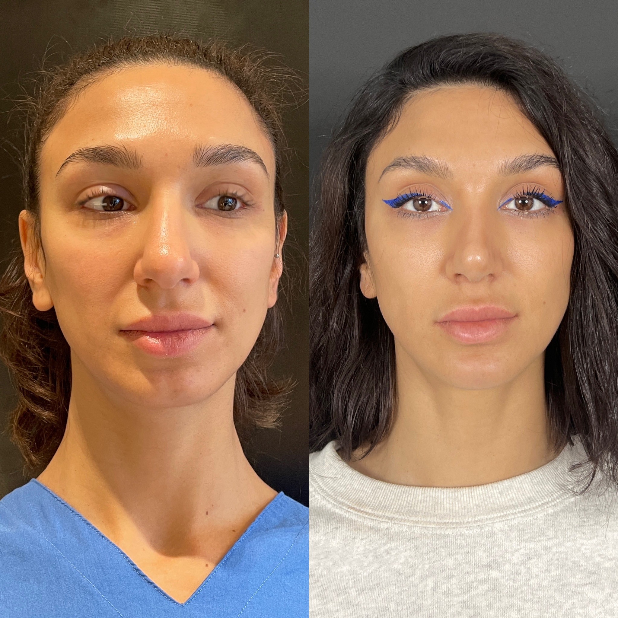 3 weeks post-surgery before after of rhinoplasty front view