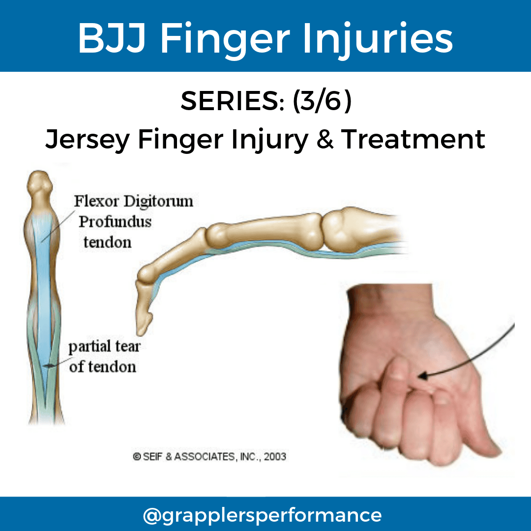 Illustration of jersey finger injury showing rupture of the flexor digitorum profundus tendon. The ring finger is unable to bend at the DIP joint, with tendon retraction into the palm.
