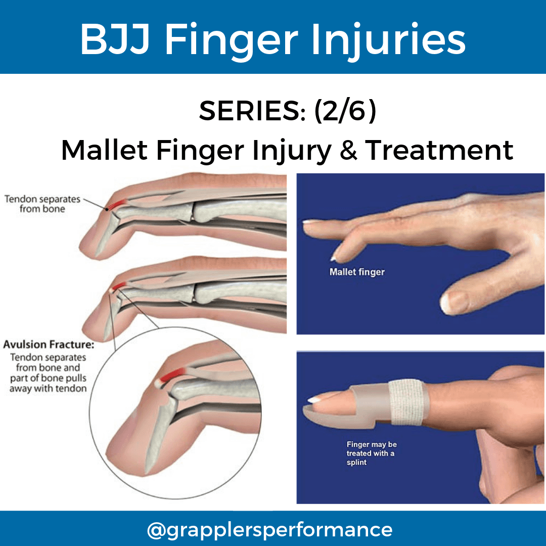 Diagram of mallet finger injury showing damage to the extensor tendon at the distal interphalangeal (DIP) joint. The fingertip droops downward in flexion while the rest of the finger is straight.