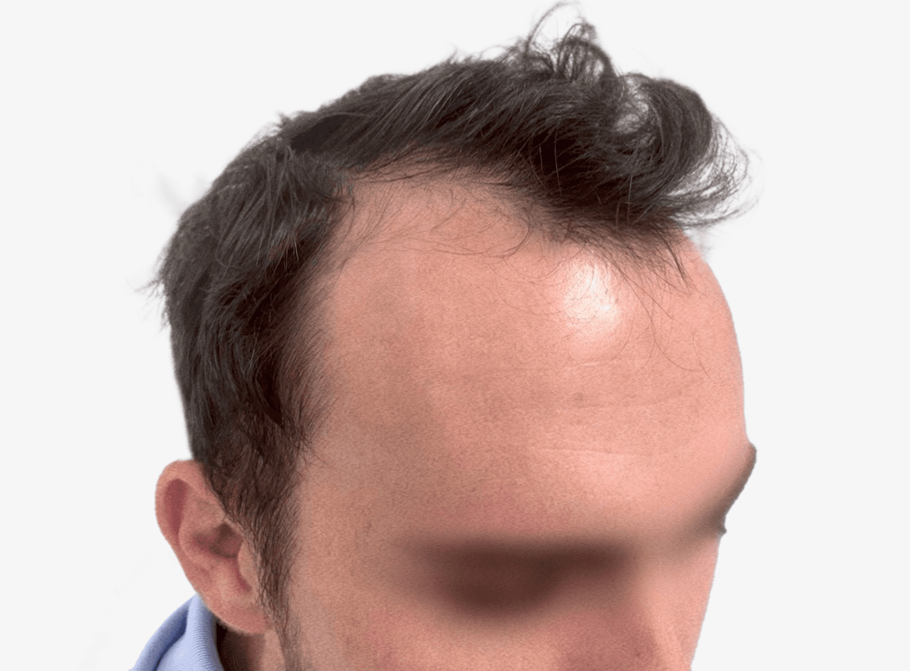 before FUE Hair Transplant