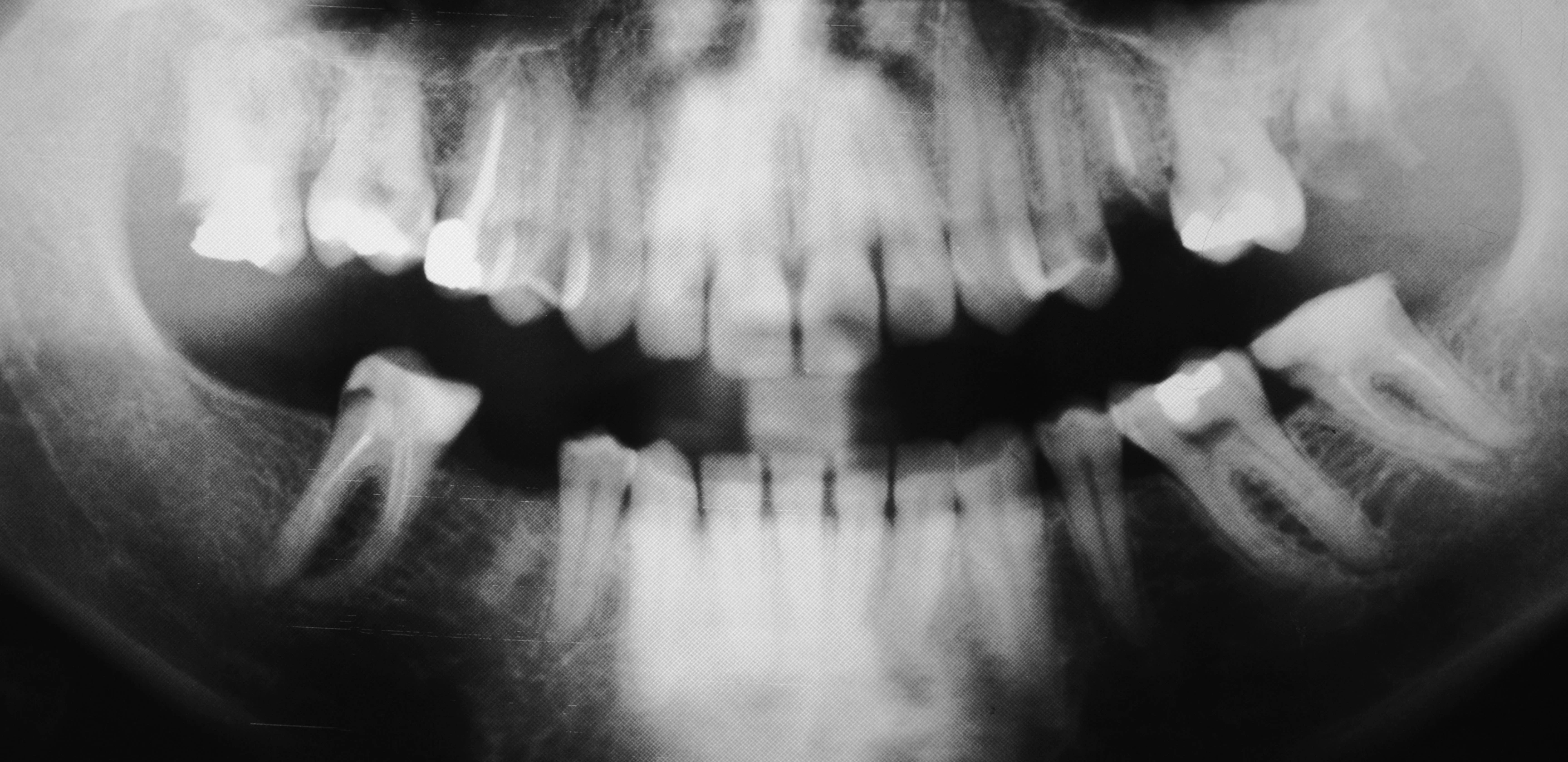 X-ray of the jaw