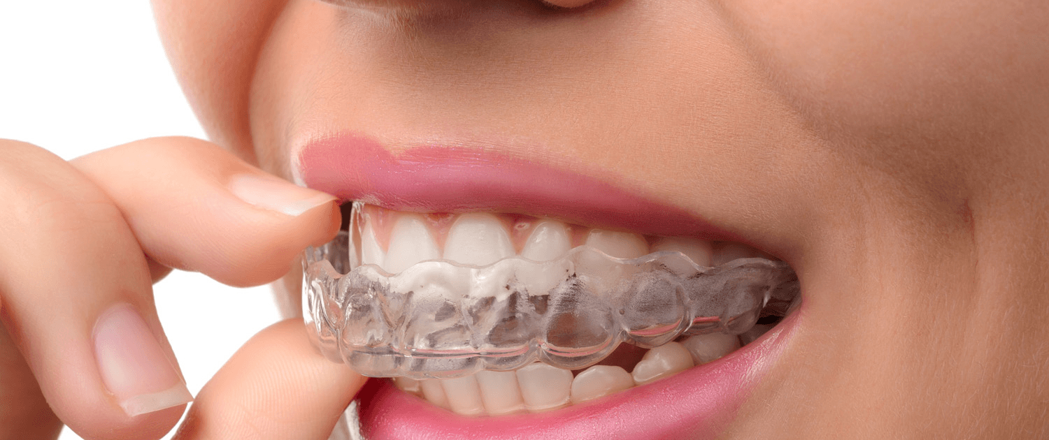 aligners