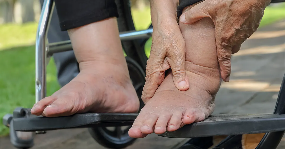 Bilde av en person med et hovent ben.