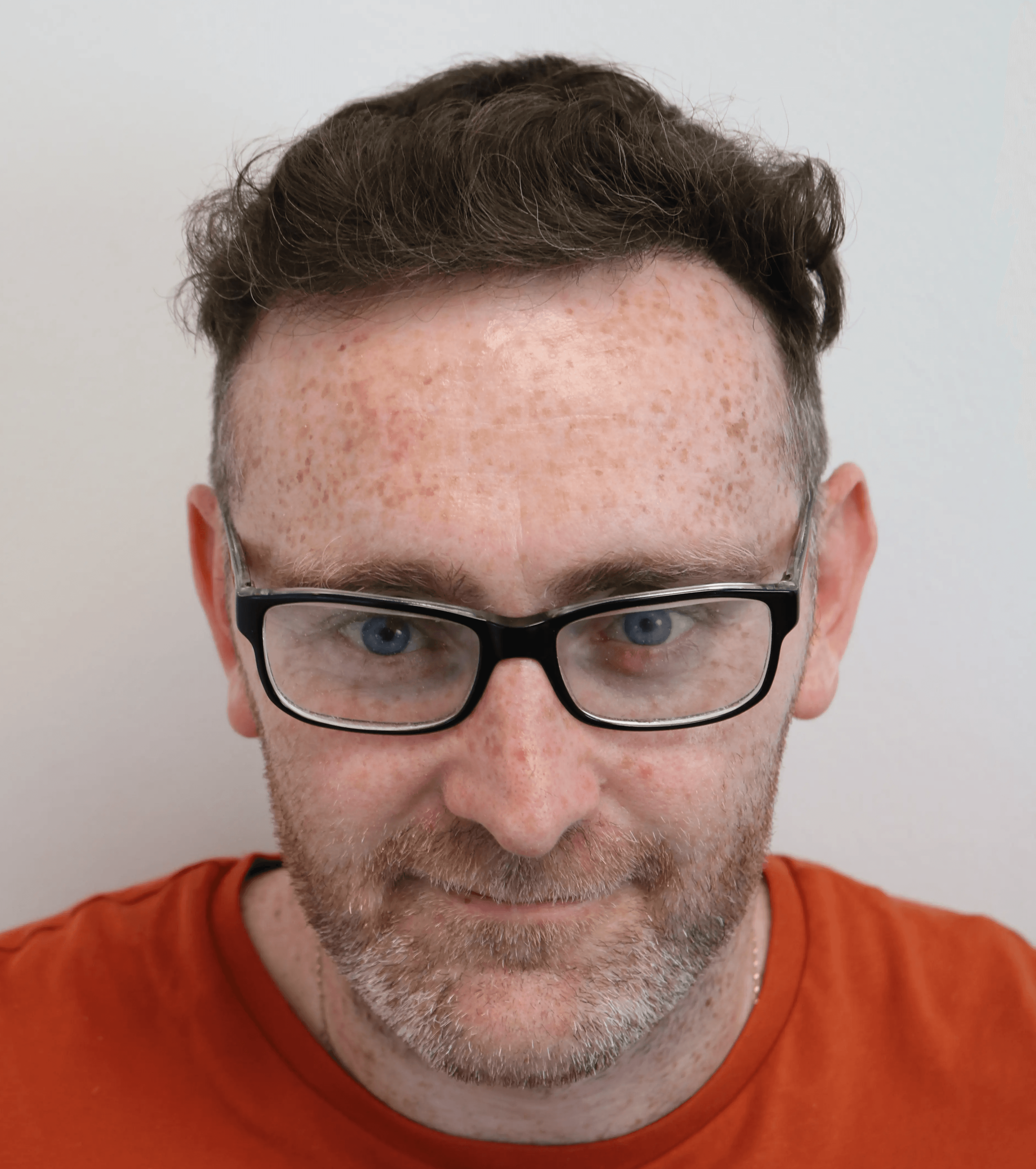 After hair transplant – Ben's FUE Hair Transplant