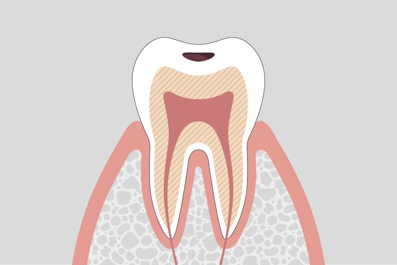 むし歯の進行段階とその治療方法