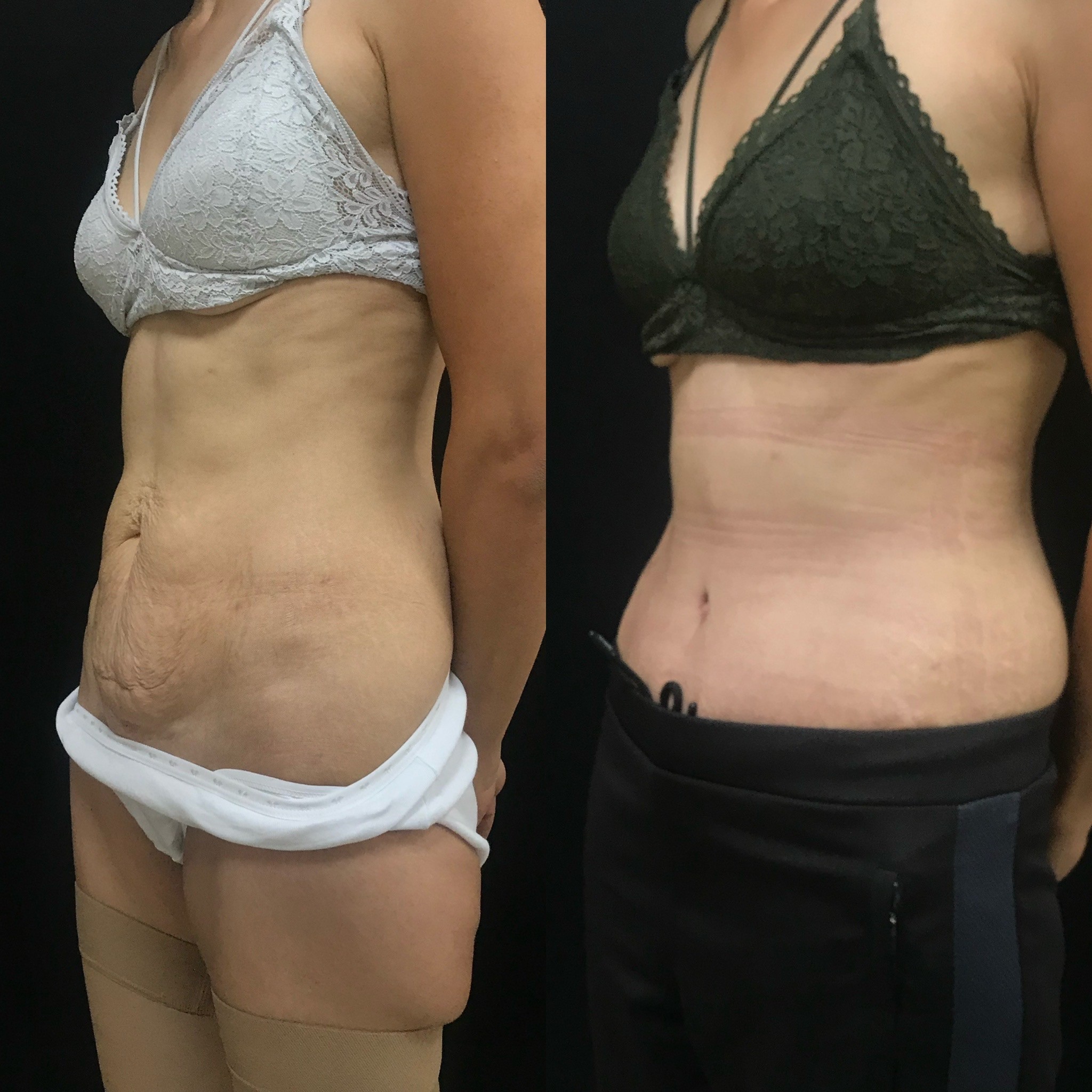 tummy tuck result before after 1 month post-op oblique2 view