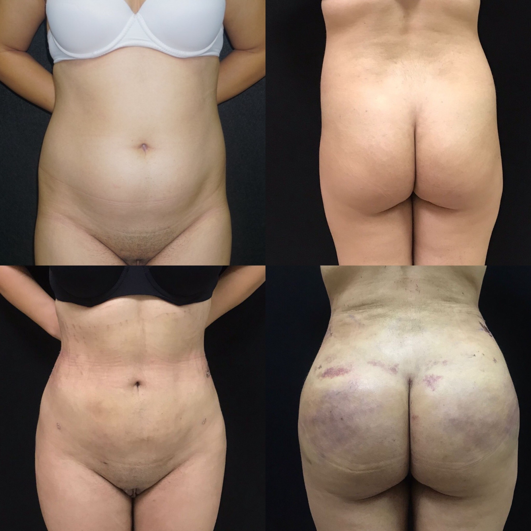 BBL before after - 3 days post-op vaser liposuction laser skin tightening and fat injection to buttocks