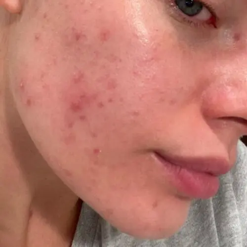 Before acne treatment at The Vancouver Aesthetician — moderate acne with visible papules, congested blackheads and whiteheads on skin