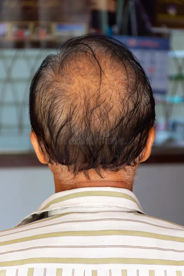 thinning hair