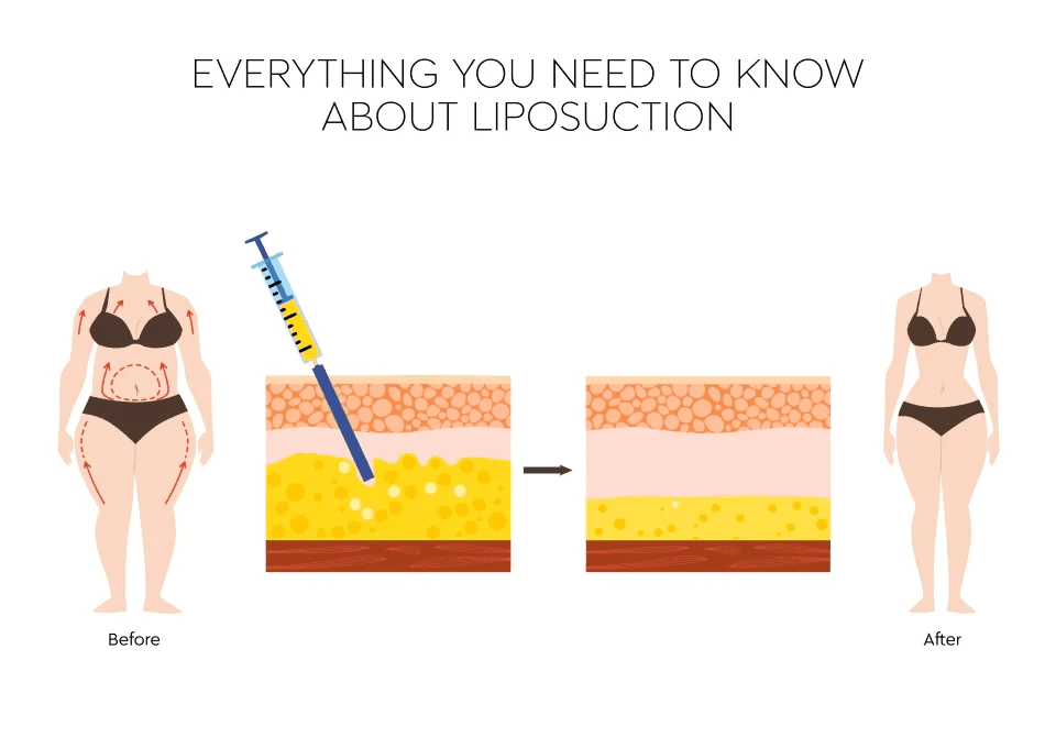 Liposuction vs Liposculpture: What’s the Real Difference?