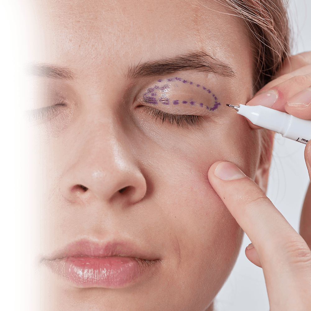 üst blefaroplasti iz yerleşimi