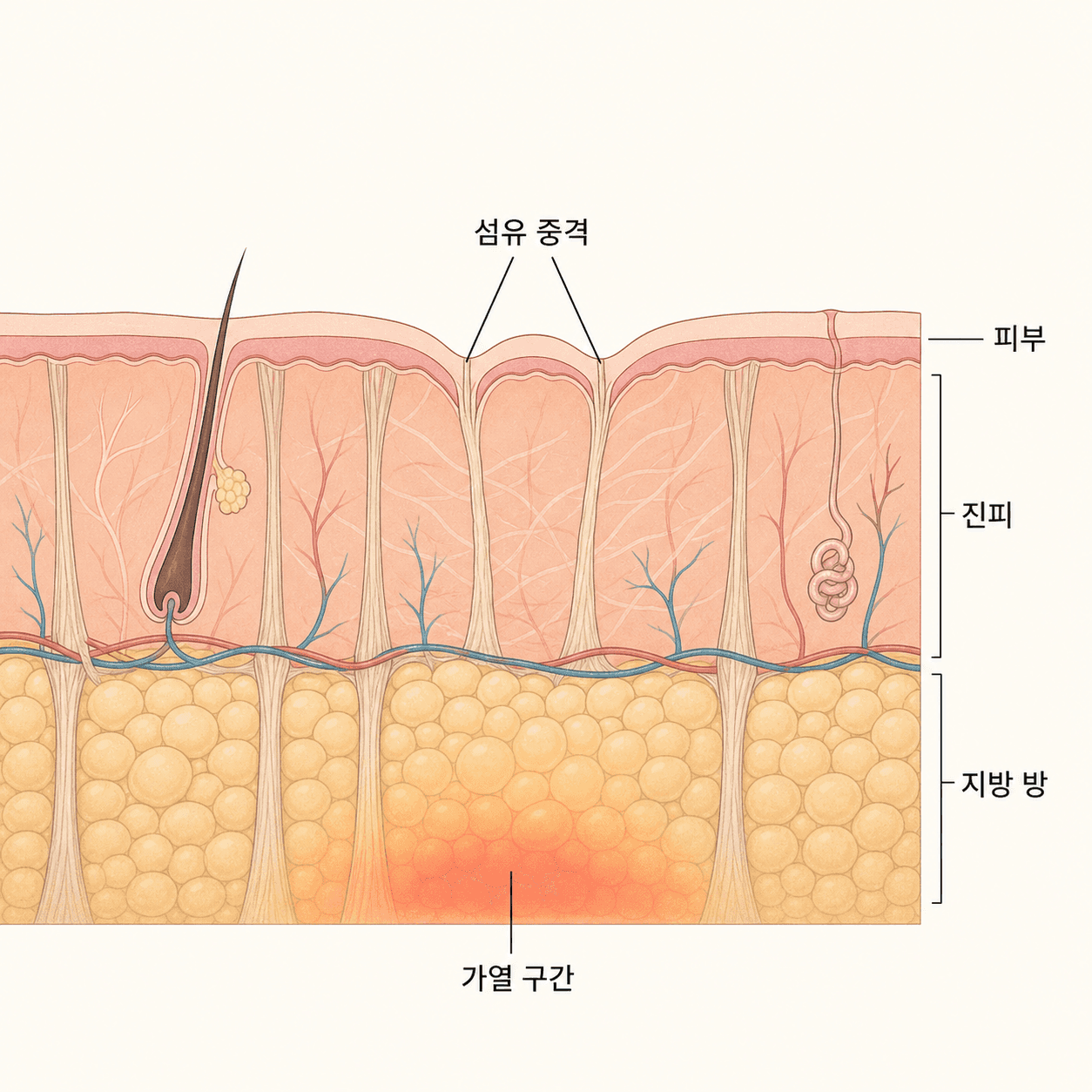 섬유 중격이 피부를 아래로 당겨 굴곡을 만드는 셀룰라이트 구조와 깊은 지방의 가열 구간