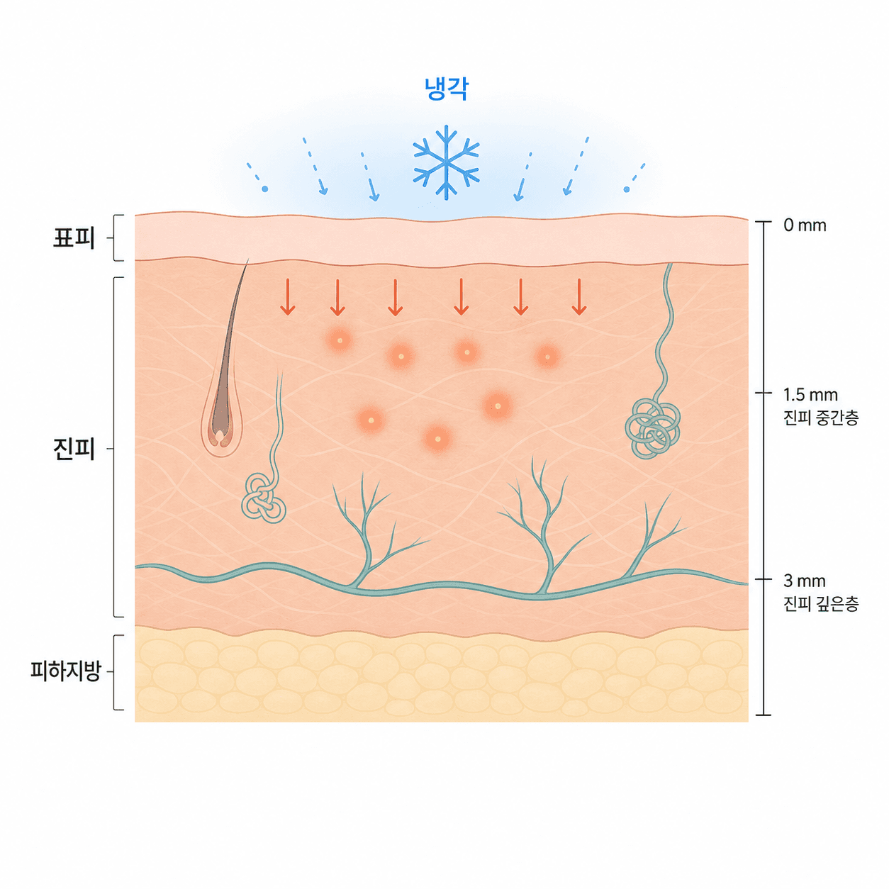 표면은 식히고 진피에 전달되는 고주파 열