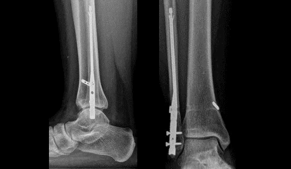 X-ray of Minimally Invasive Ankle Surgery