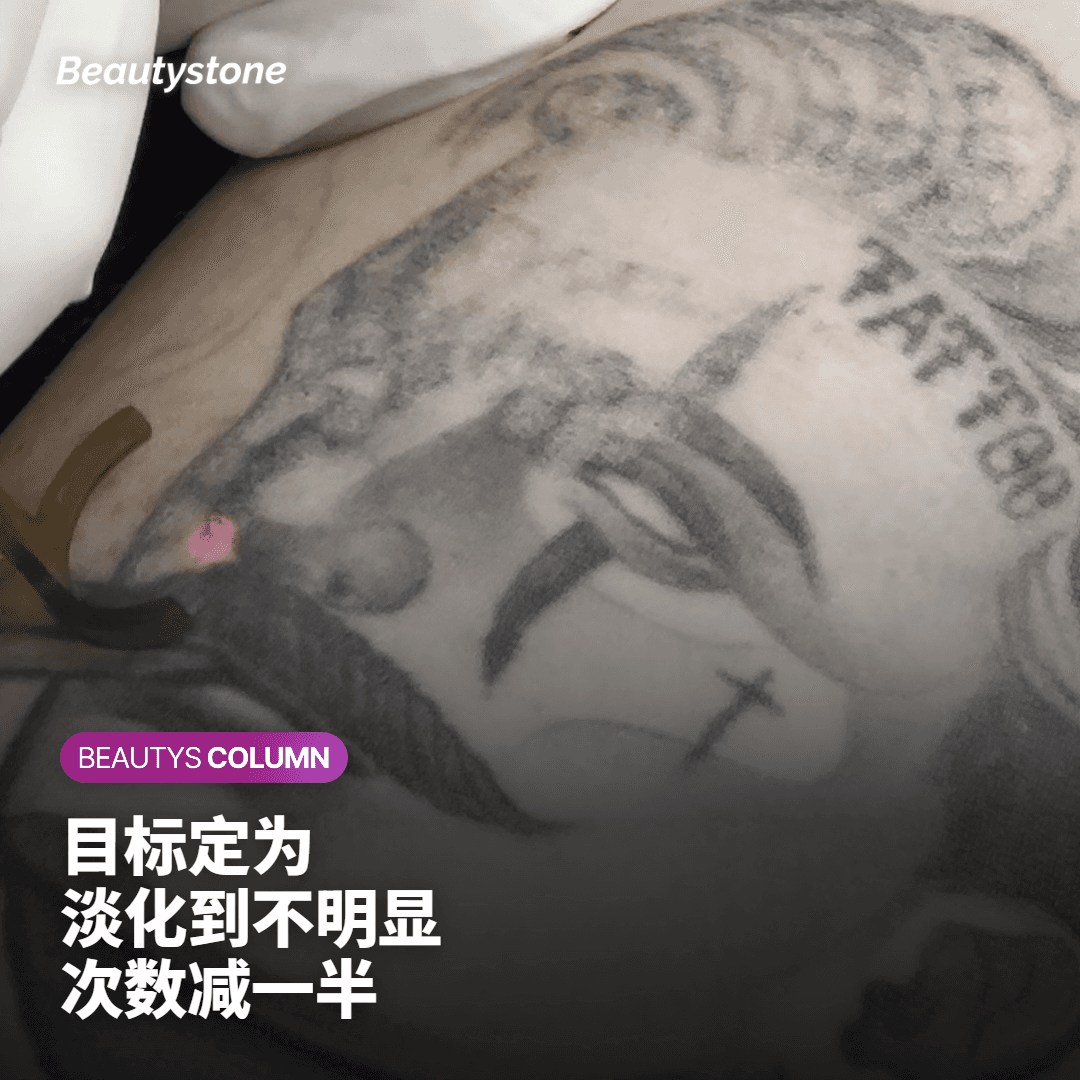 将时间、费用与疤痕负担减半的小纹身“分阶段局部去除”方案