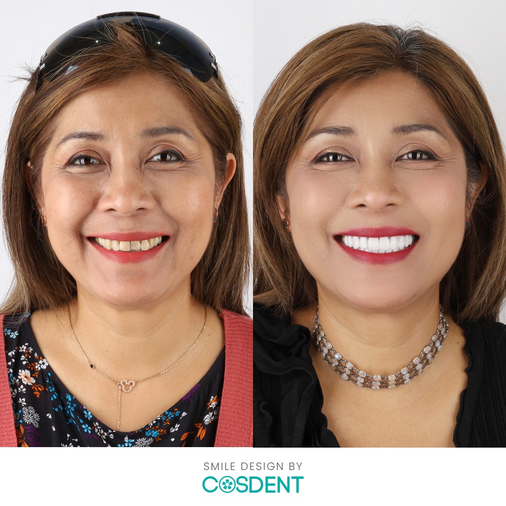 ผลงานการเปลี่ยนแปลงรอยยิ้มที่ COSDENT