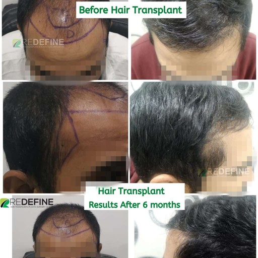 ReDefine | Hair Transplant Clinic