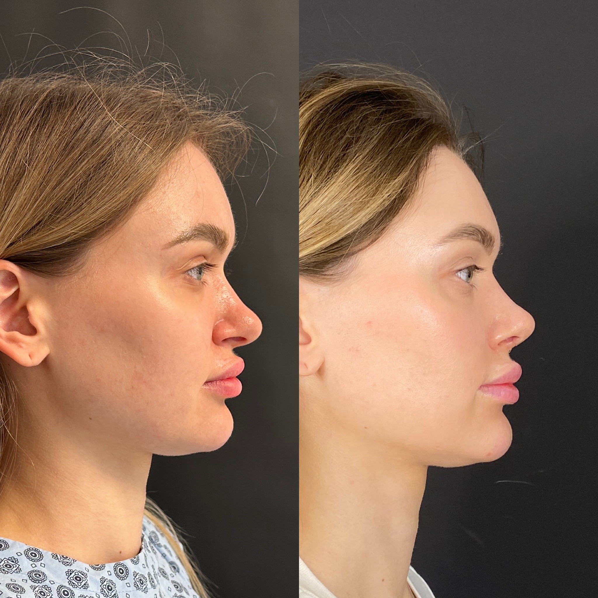 5 days cast removal of rhinoplasty before after right side view