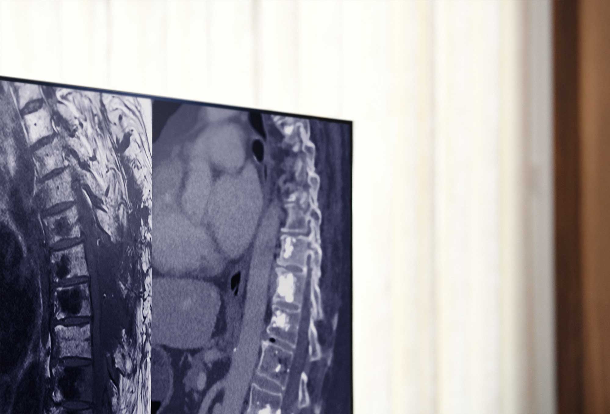 Wirbelsäulentumore und -metastasen