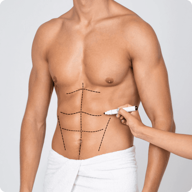 Close-up view of a man's abdomen before undergoing liposuction, showcasing areas with excess fat that he wishes to reduce. The man has a neutral expression, and the clinical setting highlights the areas of focus for the procedure aimed at achieving a more sculpted and defined physique.