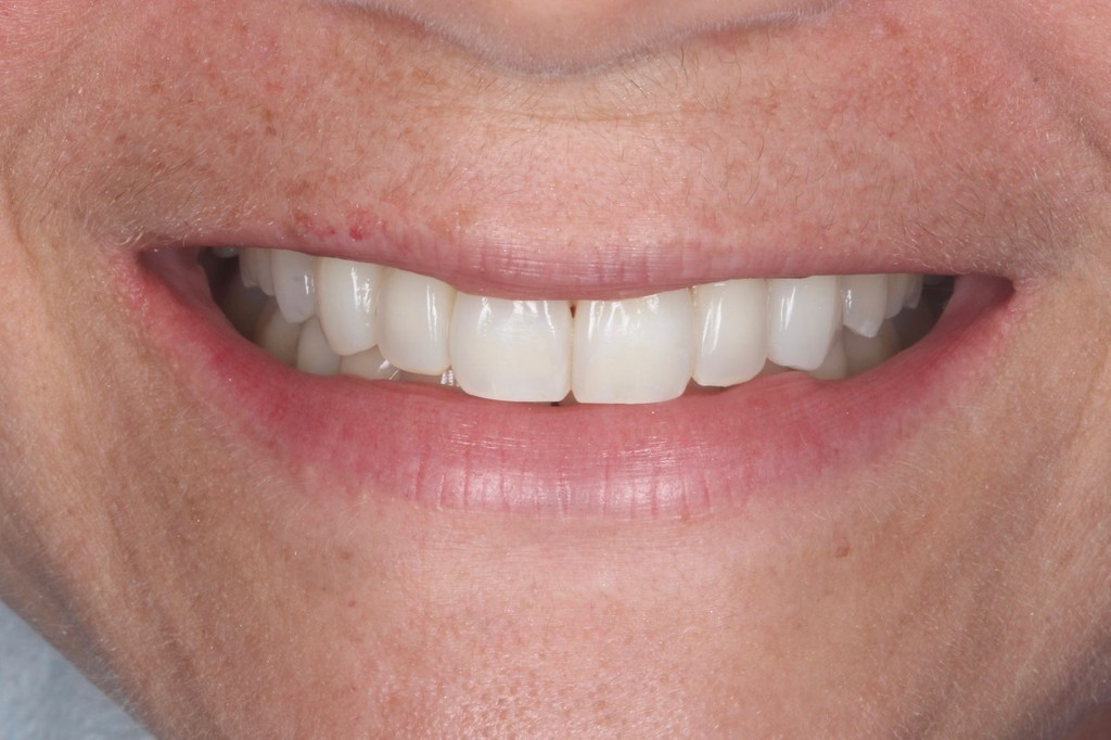 Depois do tratamento com alinhadores