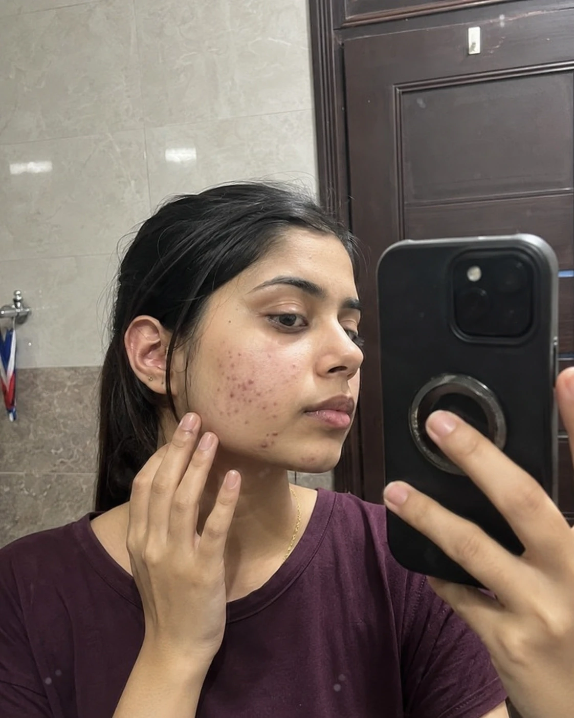 Woman with acne