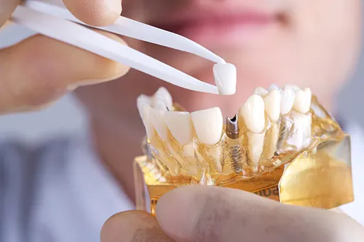 smyrna dental implants