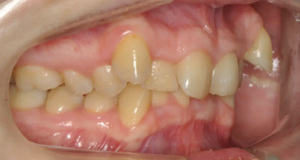Prima e dopo il trattamento ortodontico funzionale, senza estrazione dei denti premolari