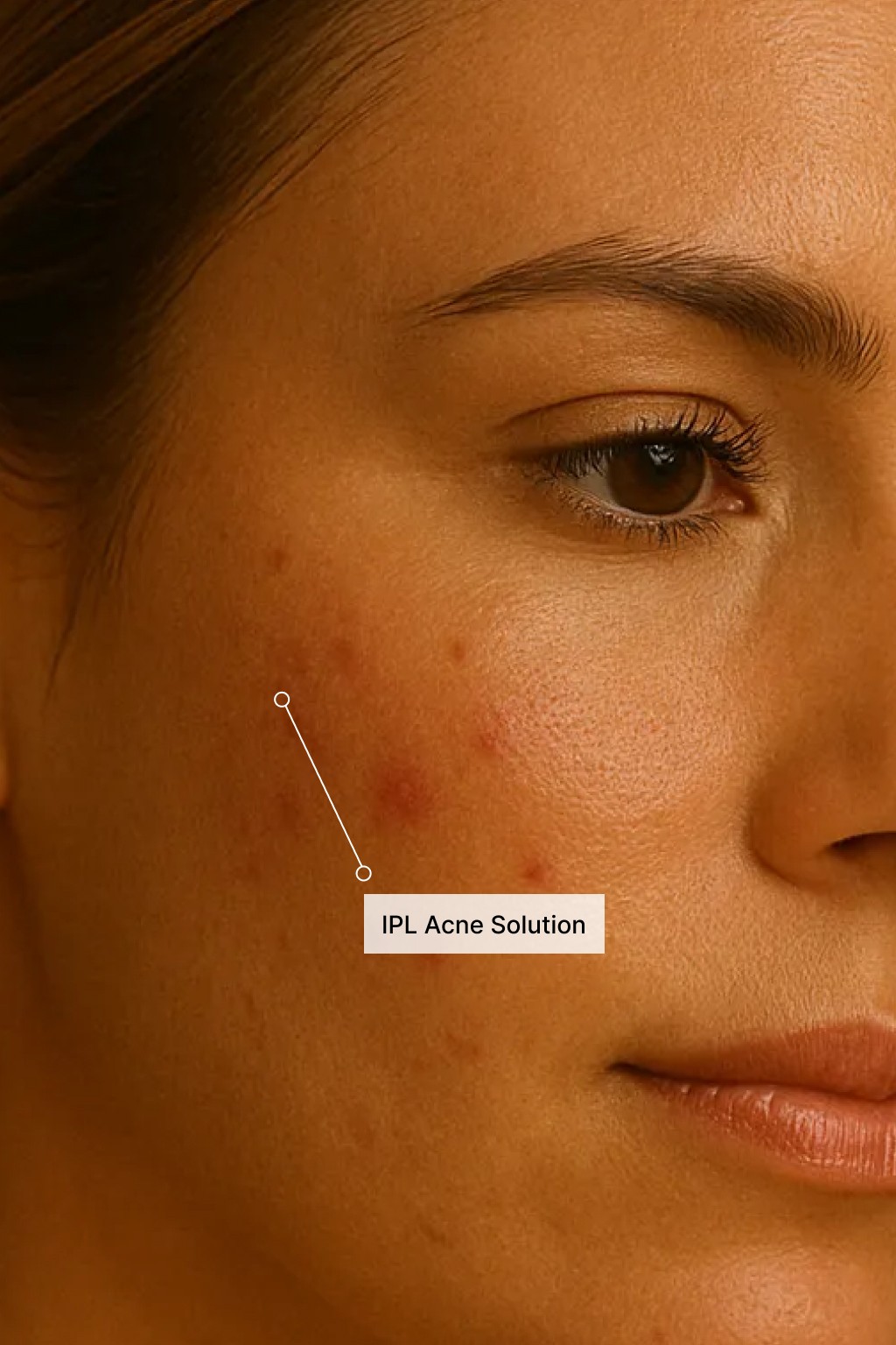 Close-up of a woman’s hairline with an area highlighted for a laser hair-loss and hair-growth stimulation treatment.