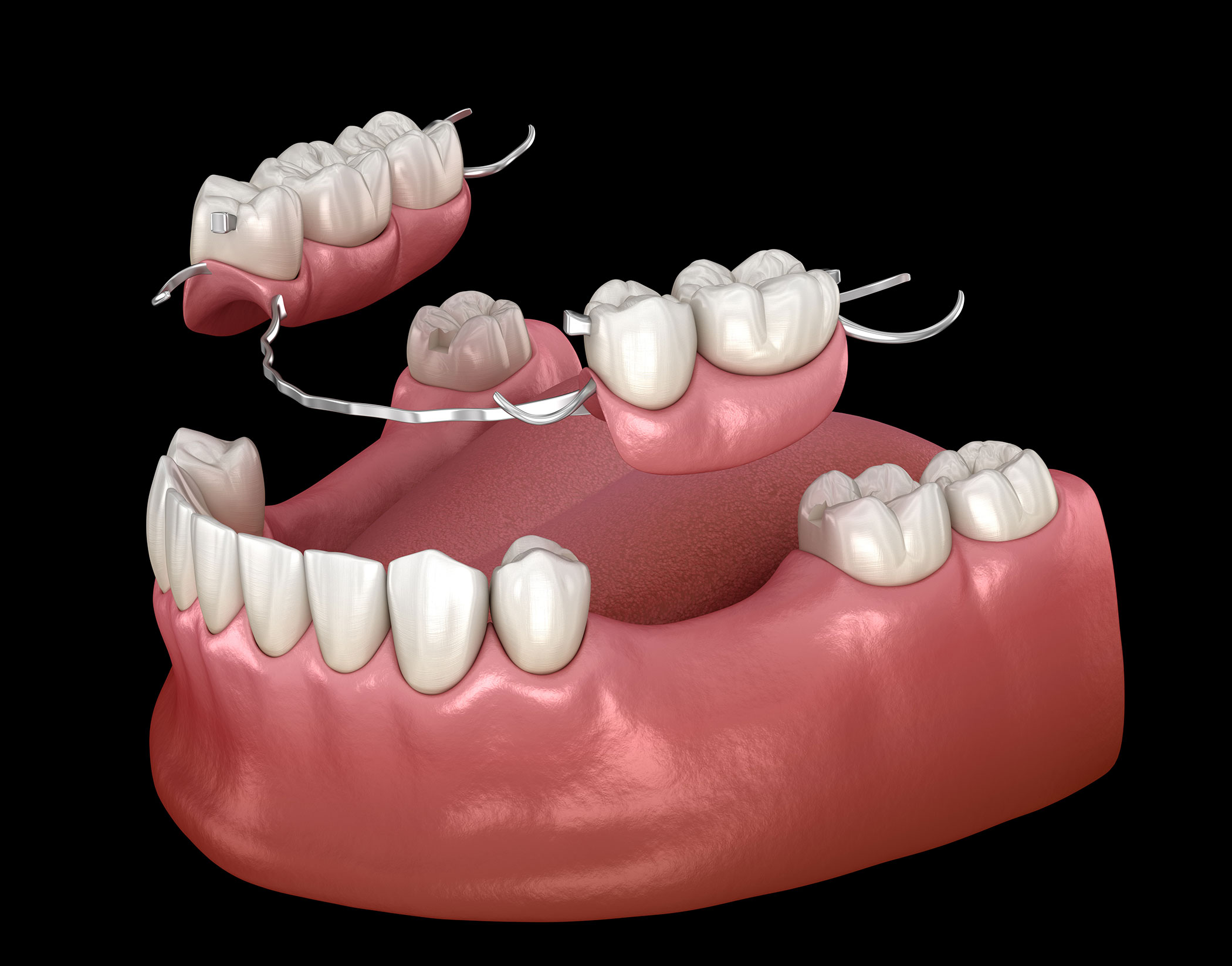 Removable partial dentures