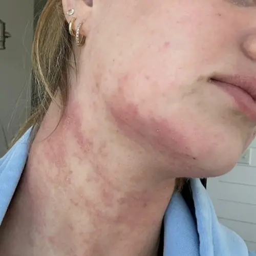 Before lipids and ceramides treatment at The Vancouver Aesthetician — visible dermatitis with red and irritated skin on face and neck