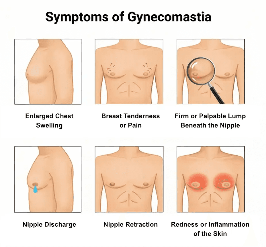 Diagram explaining excess gland and fat tissue in gynecomastia
