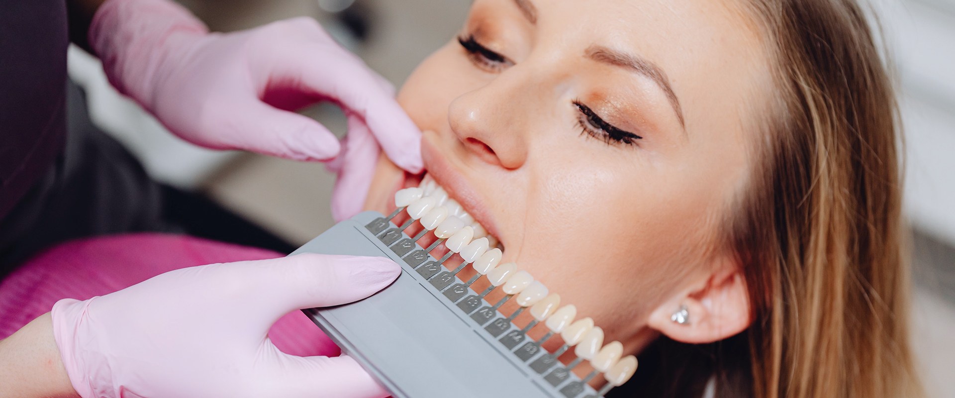 Whitening, veneers, or bonding: how to choose