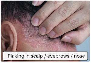 Flaking in scalp/eyebrows/nose folds