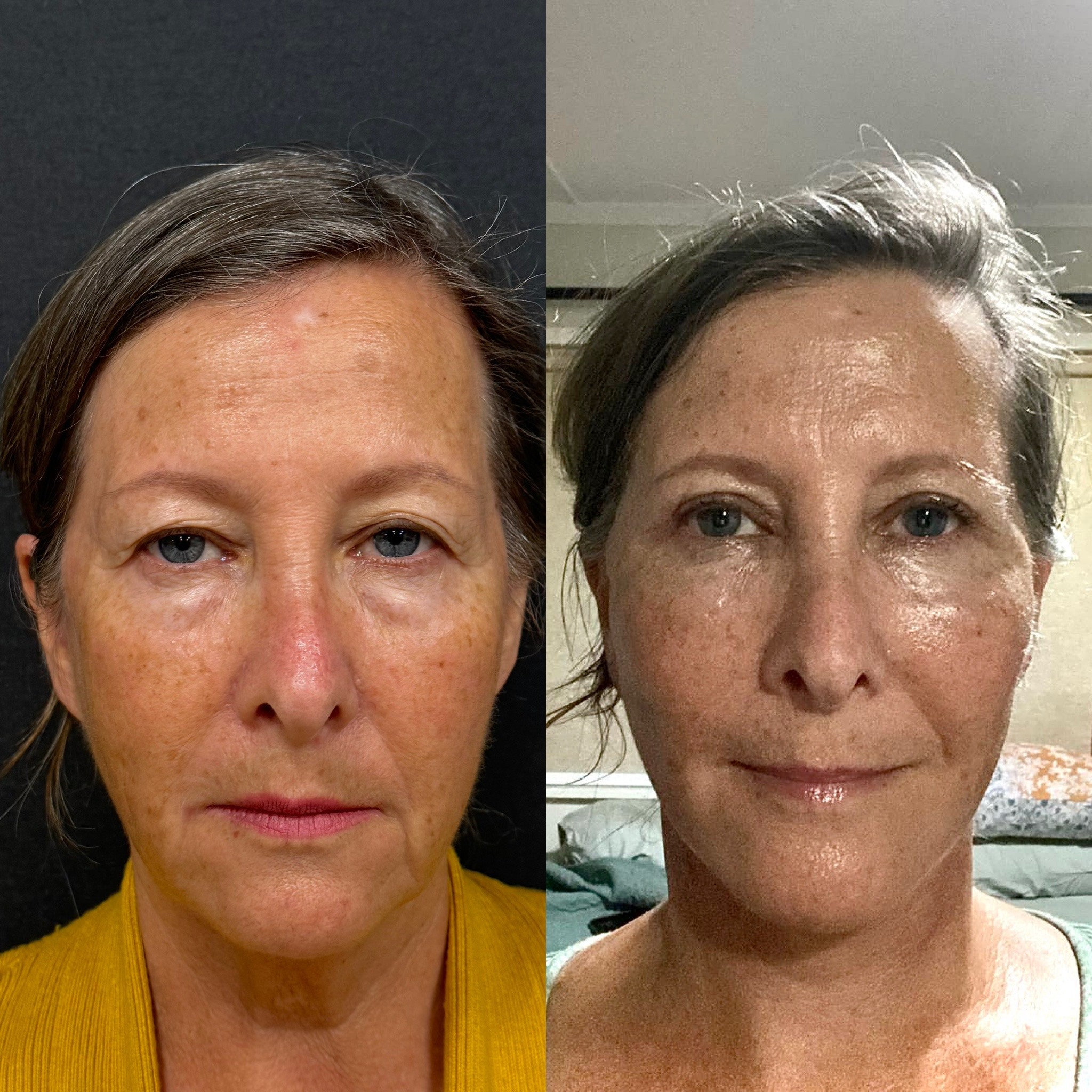 1 month before after deep plane face neck lift front view