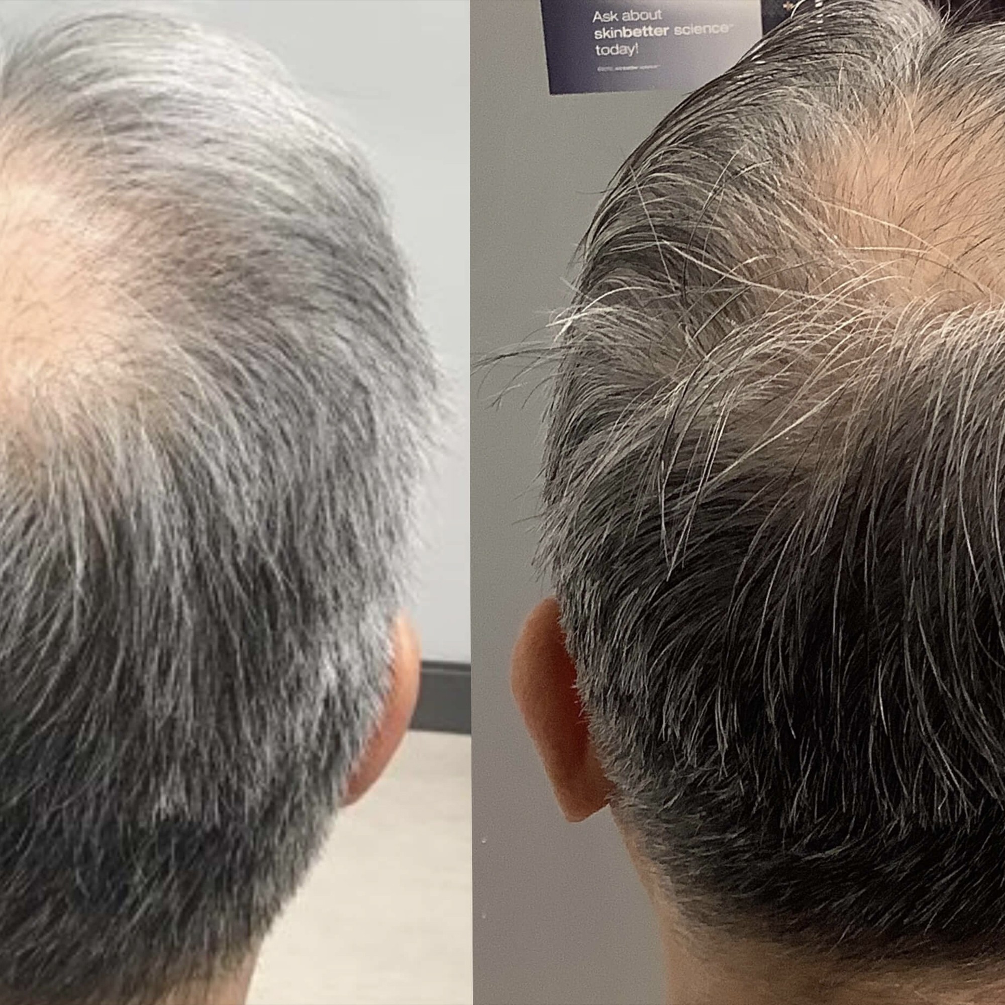 TED hair loss restoration treatment
