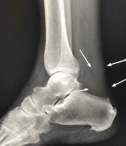 Image shows Achilles Tendinitis x-ray