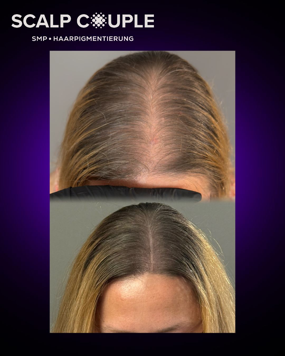 Haarpigmentierung Frau Vorher Nachher – Stufe 2 bei mittlerer Ausdünnung | Scalp Couple